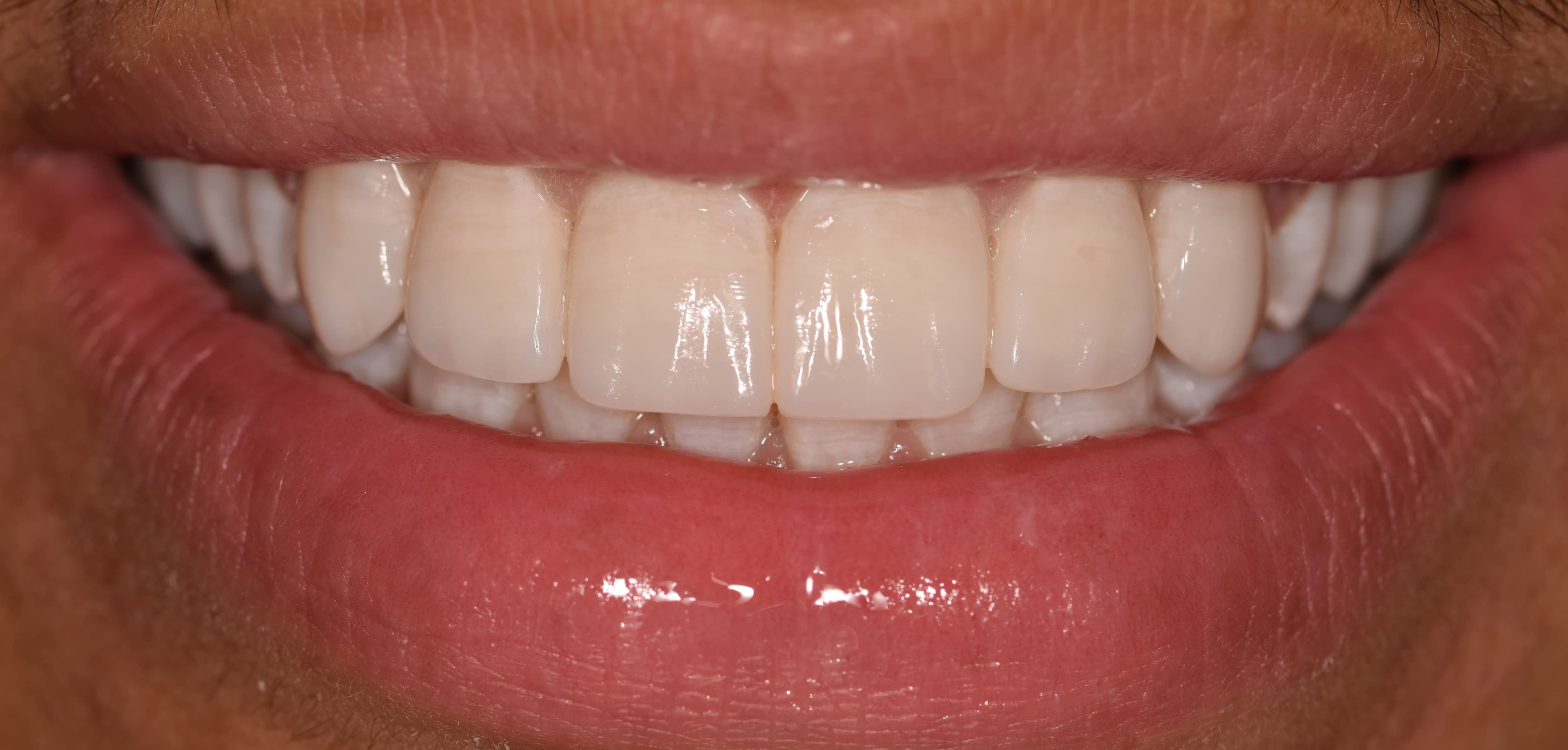 Porcelain Veneers on 4 after