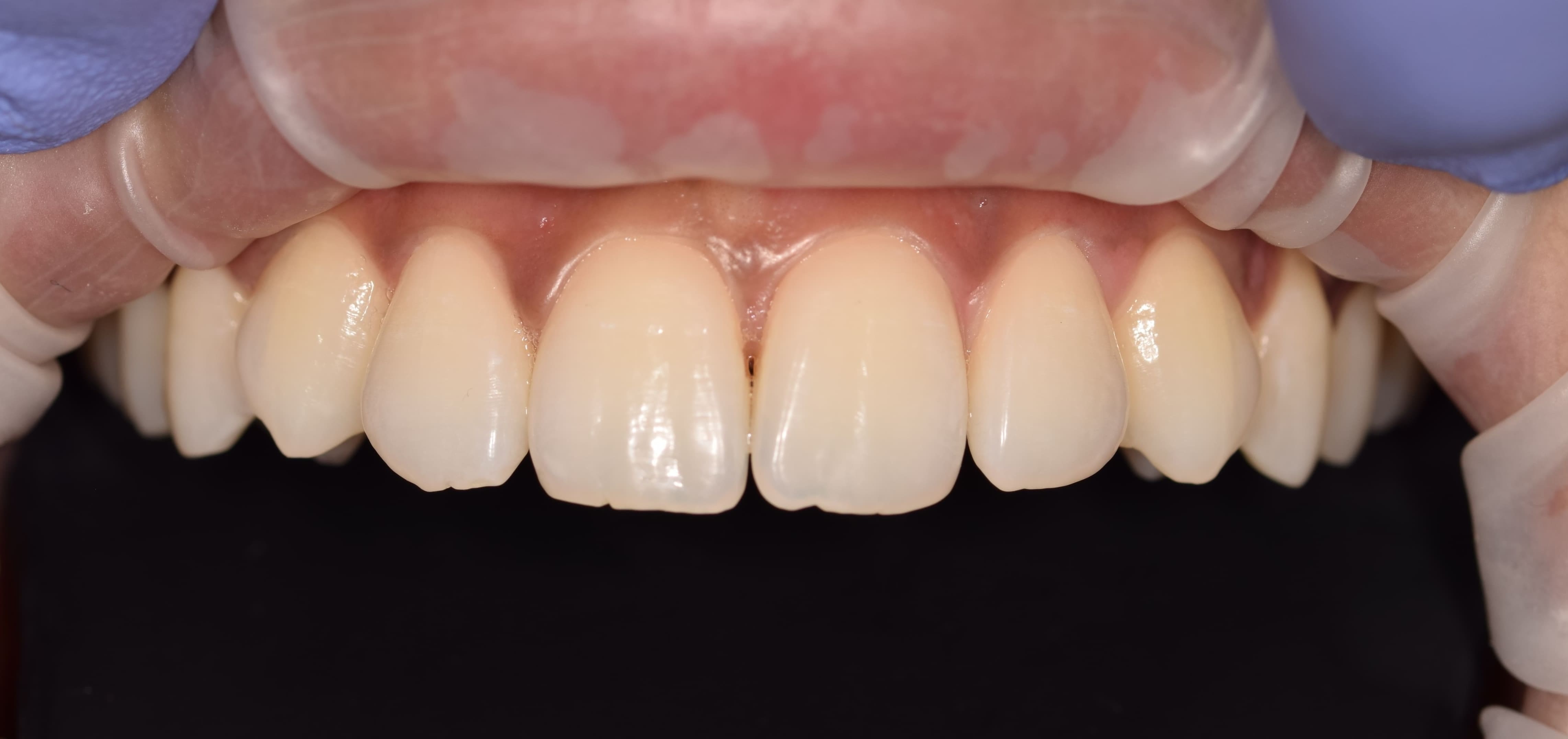 Composite Bonding before